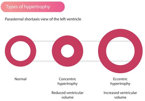 eccentric hypertrophy definition.